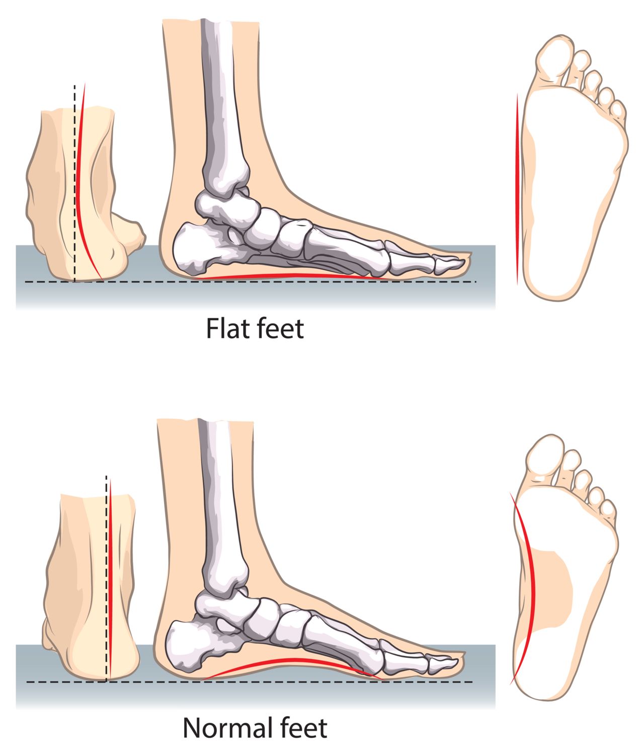 Flat feet and best sale balance