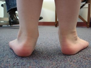 childs flat feet