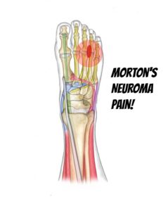 neuroma