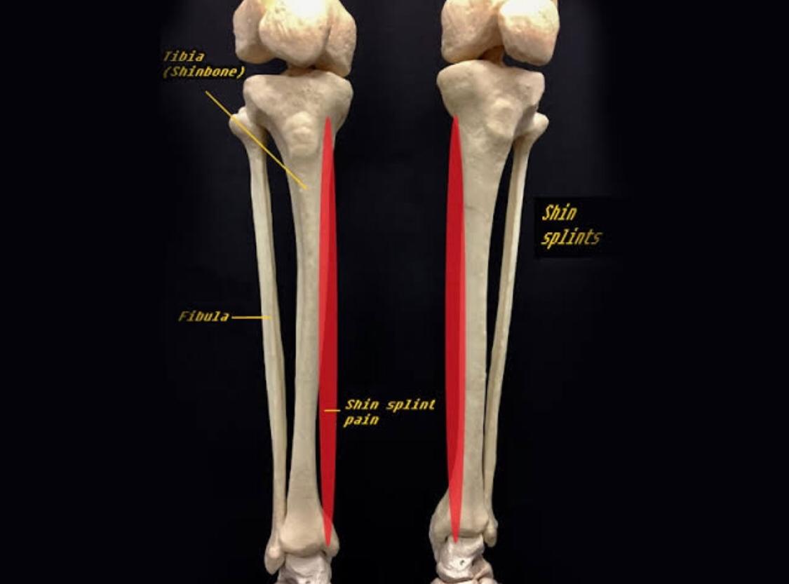 shin splints from flat feet