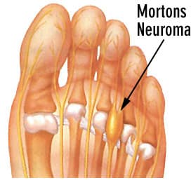 causes-neuroma