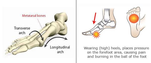 metatarsal-bone