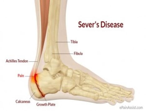 Heel Pain in Kids