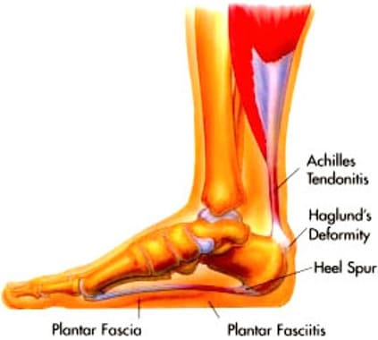 Heel pain