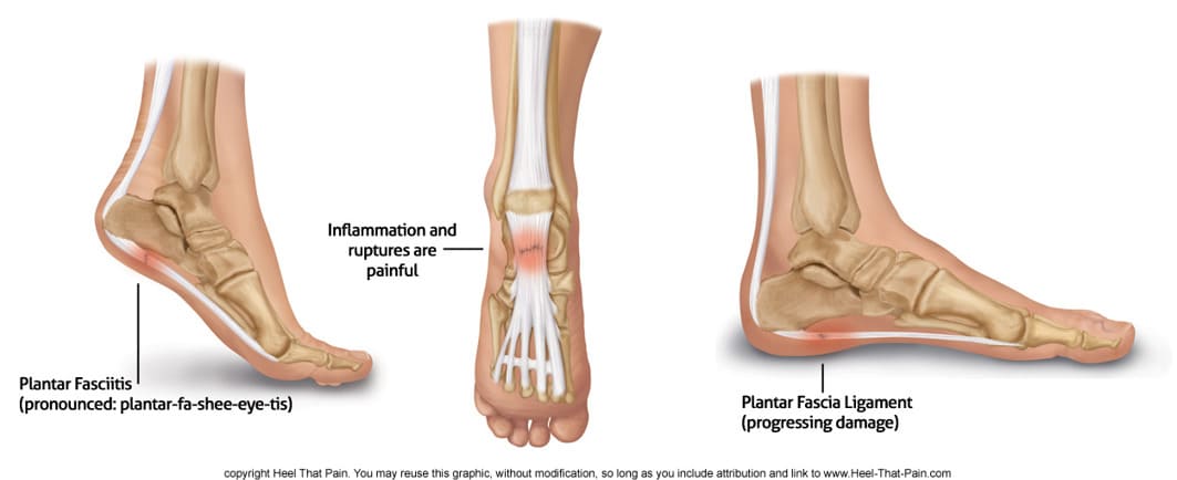 Pain in the Bottom2