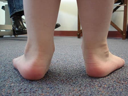Children with flat feet