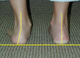 severe flat feet